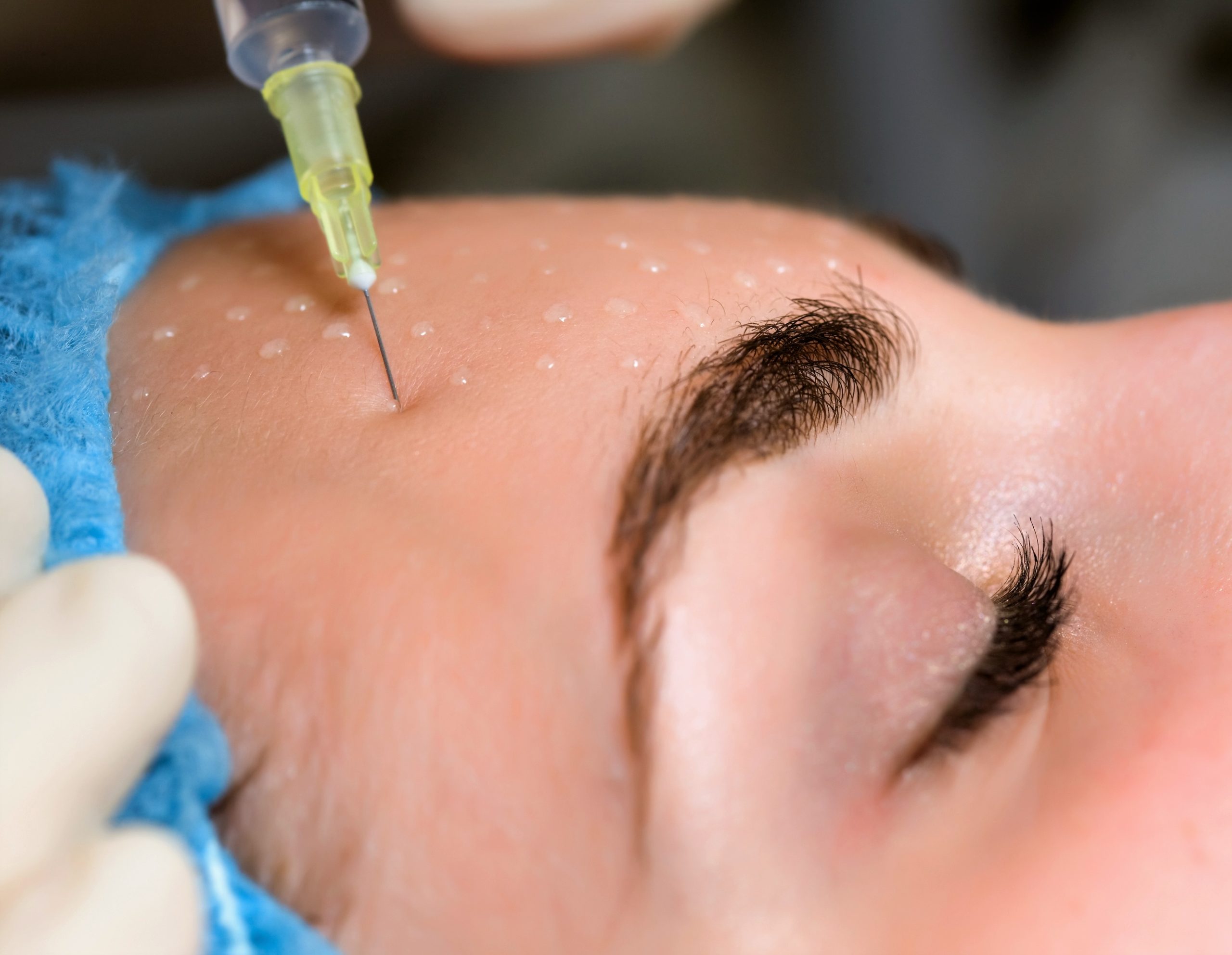 Mesotherapy 1 Mezoterapi Enjeksiyonu Dermatoloji