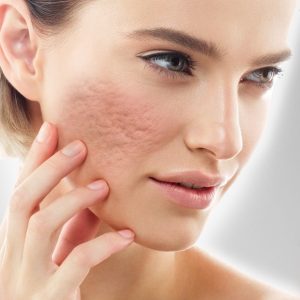 Akne izi tedavisi İzmir Alsancak muayenehanesinde Dr. Orhan Demirer ile cilt izlerinin azaltılması ve cilt yenileme