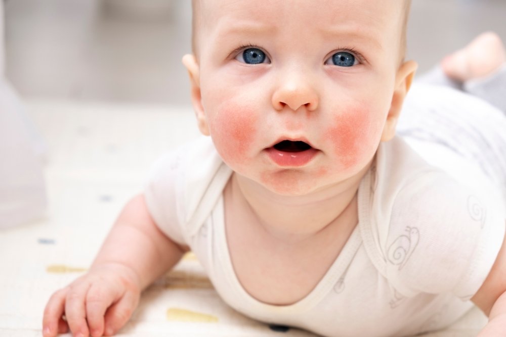 Atopik dermatit (egzama) belirtileri ve tedavisi için dermatolojik muayene İzmir’de Dr. Orhan Demirer ile kaşıntı ve cilt kuruluğu değerlendirmesi