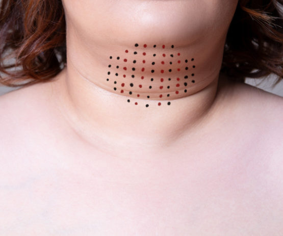 Enjeksiyon Lipoliz İzmir – Bölgesel Yağ Eritme ve Şekillendirme Rehberi 1 Enjeksiyon lipoliz uygulaması İzmir Alsancak muayenehanesinde Dr. Orhan Demirer ile bölgesel yağ eritme ve vücut şekillendirme