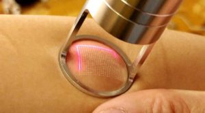 Fraksiyonel karbondioksit lazer tedavisi İzmir Alsancak muayenehanesinde Dr. Orhan Demirer ile cilt yenileme, akne izi ve leke tedavisi