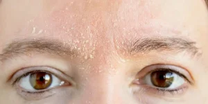 Seboreik dermatit İzmir