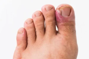 Tırnak batması tedavisi İzmir